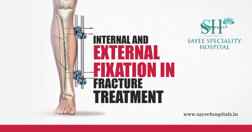 Internal and external fixations in fracture treatment
