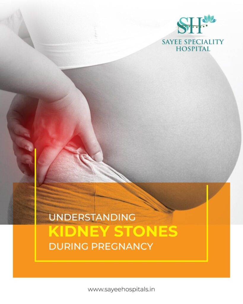 Understanding Kidney Stones During Pregnancy