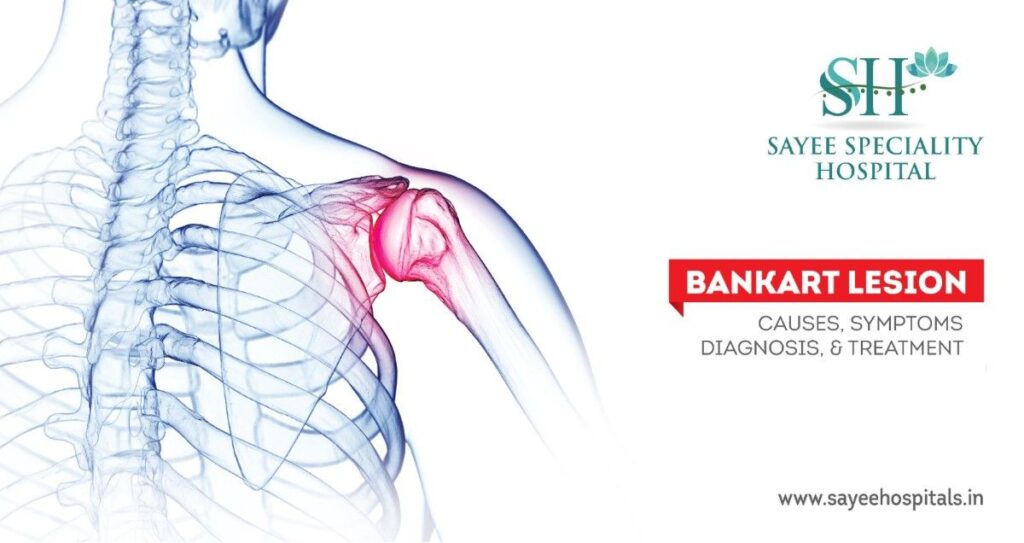 Bankart Lesion: Causes, Symptoms, Diagnosis, And Treatment
