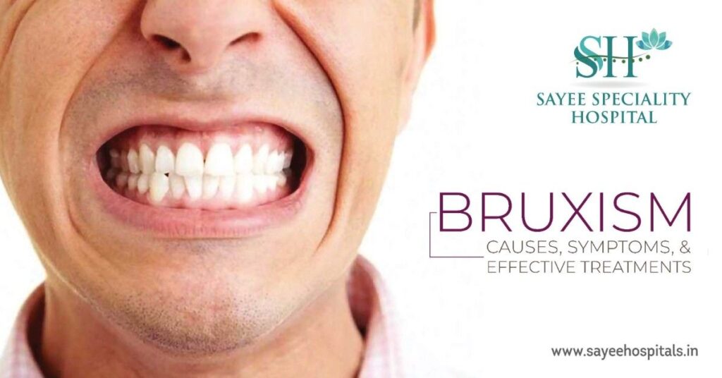 Bruxism: Causes, Symptoms, And Effective Treatments