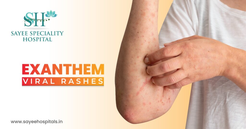 Exanthem Viral Rashes