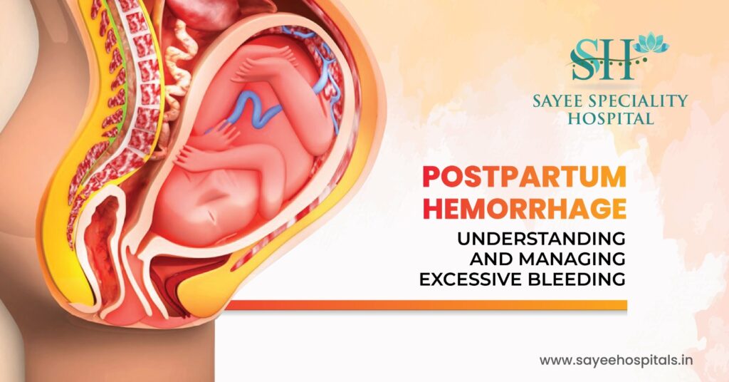 Postpartum Hemorrhage Understanding And Managing Excessive Bleeding.