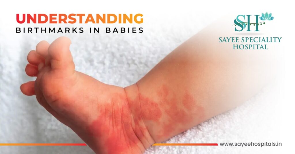 Understanding Birthmarks in Babies